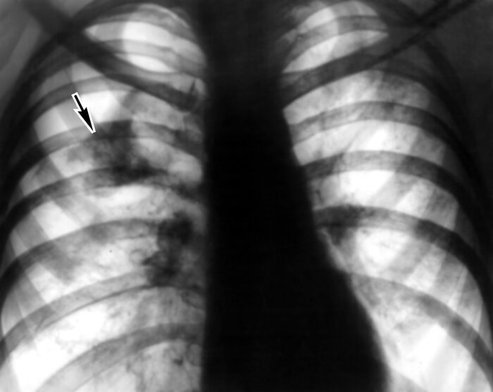 Повреждение легкого ребрами. Перелом ребер с пневмотораксом рентген. Пневмоторакс разрыв легкого. Перелом ребер пневмоторакс рентгенограмма. Пневмоторакс на флюорографии.