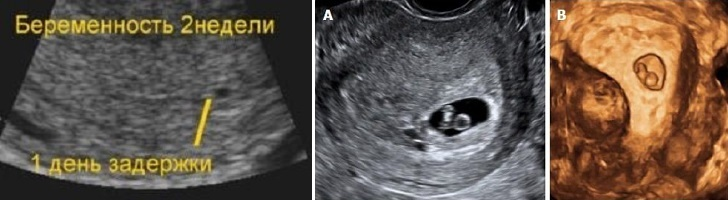 Беременность 2 3 недели. Эмбрион 2-3 недели УЗИ беременности. Эмбрион на 3 неделе беременности.