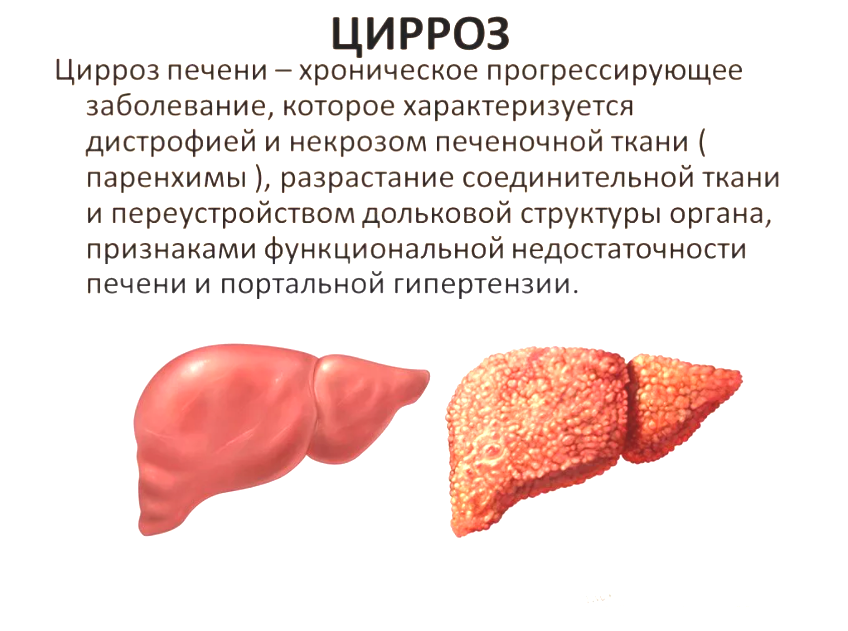 здоровая и больная циррозом печень
