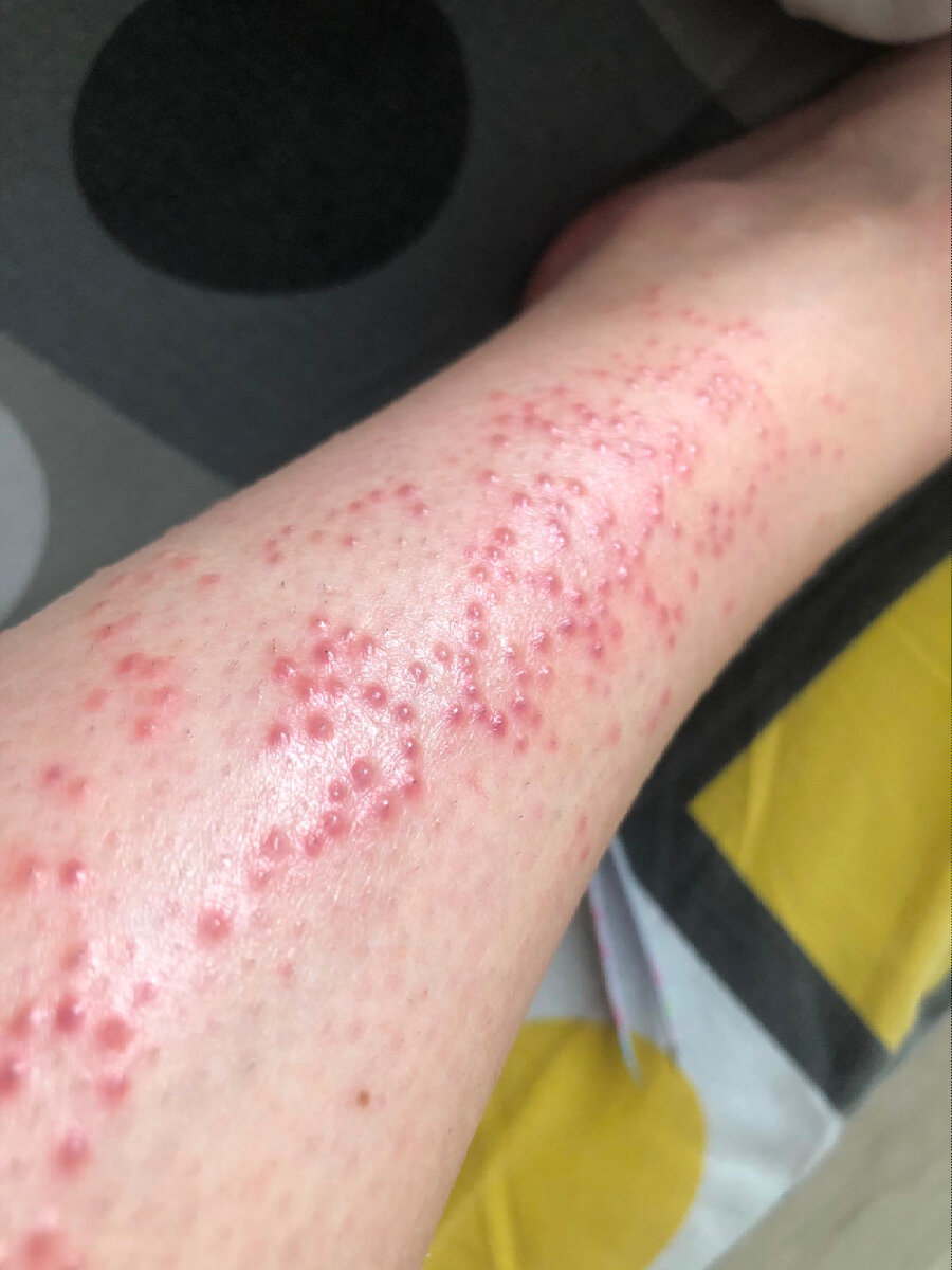 Раздражение фолликулы