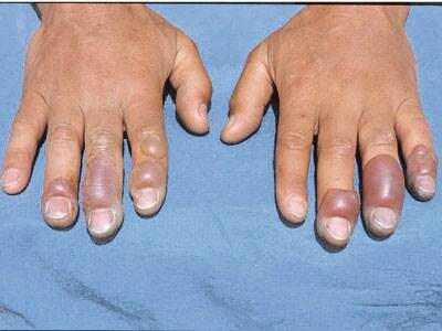  Вскрытие пузырей производится после отморожения производиться в асептических условиях.