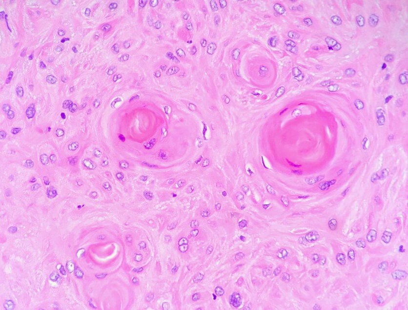   Плоская карцинома. Система ИИ отличает опасные поражения кожи от доброкачественных.