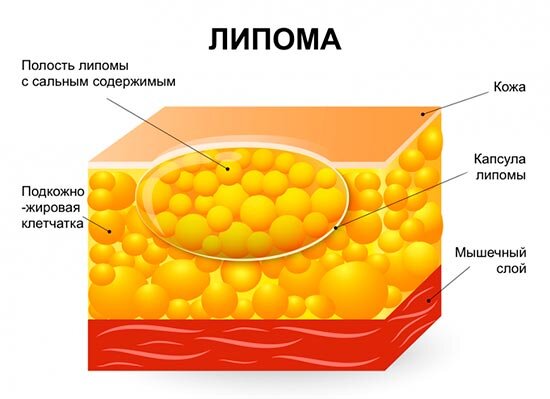 Лечение кист в молочной железе