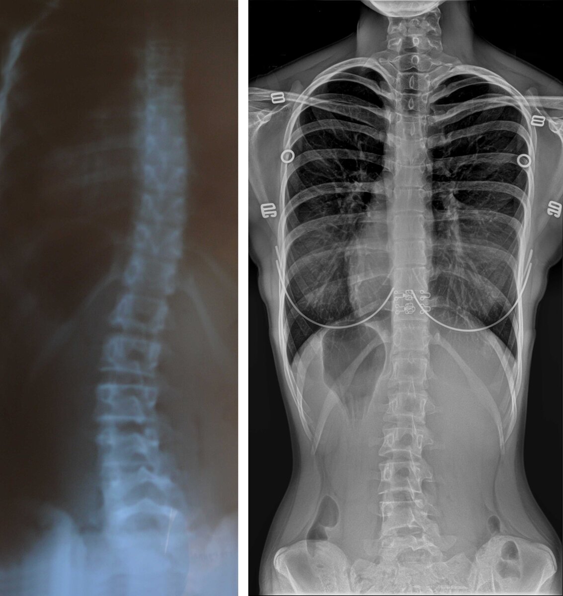 Искривление позвоночника 5. Левосторонний сколиоз рентген. Сколиоз 2 степени снимок. Сколиоз s1. Кт позвоночника сколиоз 2 степени.
