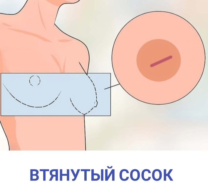 Дополнительные соски у новорожденных
