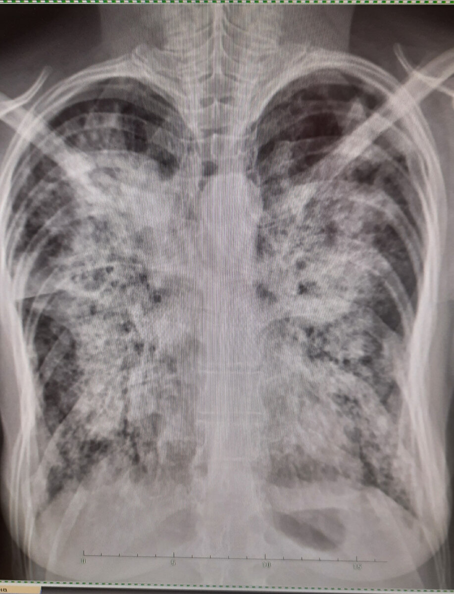 Вот такой запущенный туберкулёза выявлен у человека, который 5 лет не проходил флюорографию..