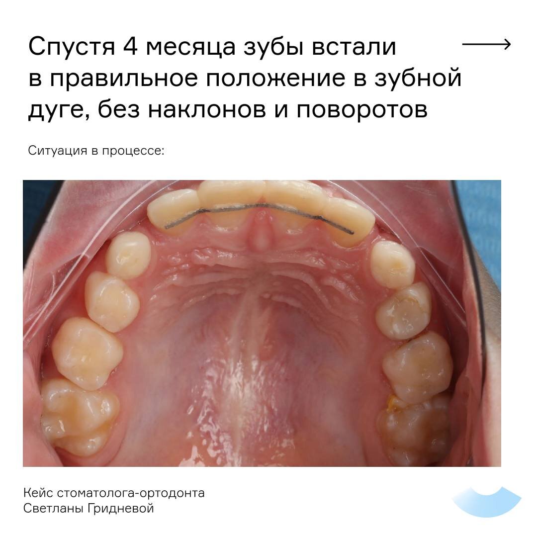 Поздние зубы у детей – проблема или норма?