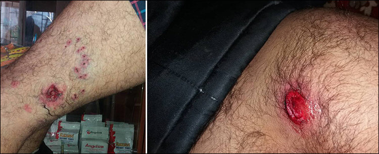 Ранения, полученные Субхоном Хамзалиевым в ногу и руку
