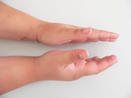 Как справиться с ушибом пальца руки
