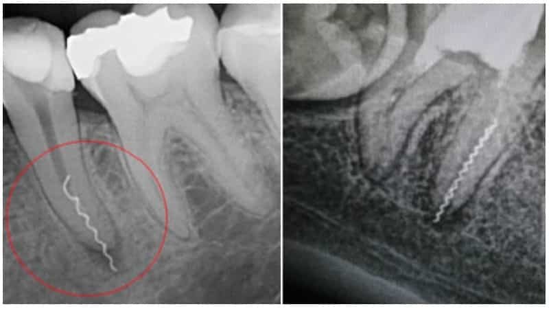 Зуб чувствителен после лечения. Межкорневая гранулема. Апикальная гранулема зуба. Перелом корня зуба пломбировка.