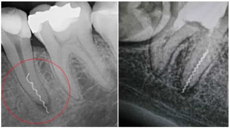 Перелом корня зуба пломбировка. Отлом эндодонтического инструмента в канале корня. Отломок инструмента в канале корня зуба. Пломбировка верхушки корня рентген.