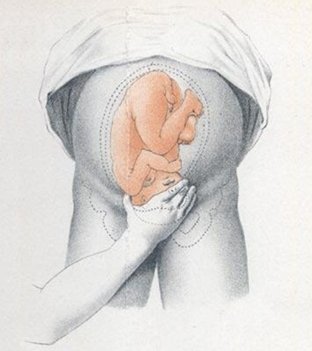 Третий акушерский прием. Приём проводят правой рукой, ее располагают чуть выше лона, большой палец максимально отводят от остальных четырех и захватывают предлежащую часть большим и средним пальцами. Цель приема — определить предлежащую часть; если предлежит головка — присутствует симптом баллотирования. Взято из Википедии.