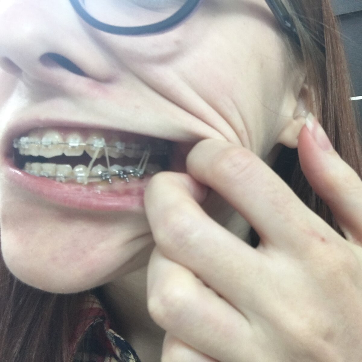 Резинки, которые ставились на последнем этапе и доставляли адскую боль...