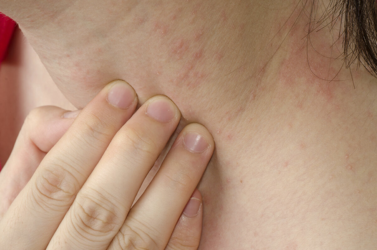 кожные заболевания на груди у женщин фото 9