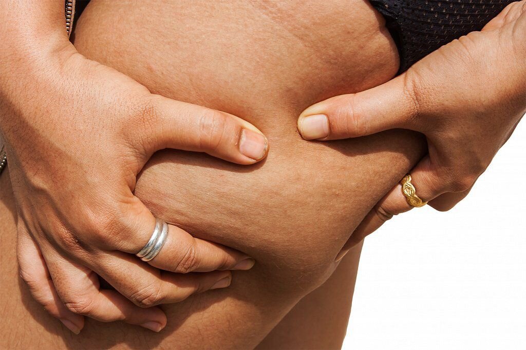  Вторая стадия патогенетически обусловлена утолщением и затвердеванием волокон коллагена в соединительнотканном матриксе жировой ткани. Затрудняется микроциркуляция крови и лимфы на капиллярном уровне. На этой стадии при нажиме на коже остаются следы-вмятины (кожа теряет эластичность).