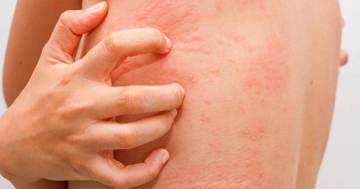 Аллергия и рак