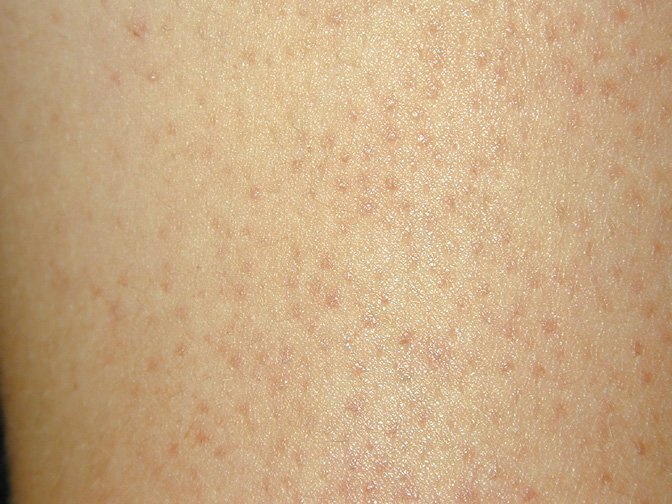 Гусиная кожа: причины, симптомы и лечение фолликулярного кератоза