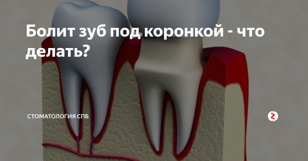 Удалять ли нерв под коронку. Болит зуб под коронкой. Больной зуб под коронкой. Если болит зуб под коронкой