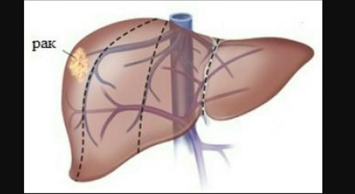 Отек печени. Гепатобластома печени. Первая стадия онкологии печени.