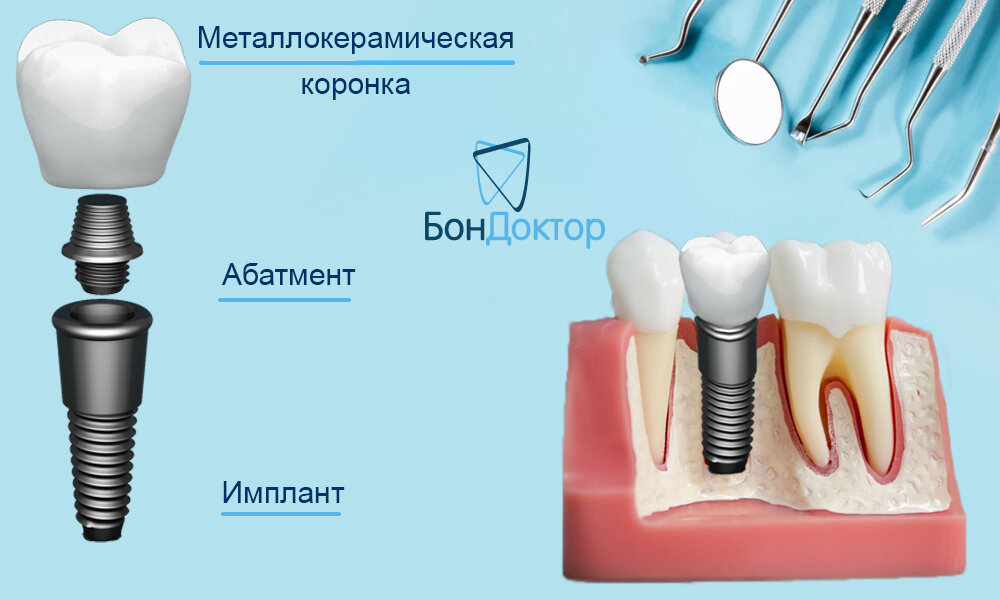 Как выглядит абатмент для импланта зуба