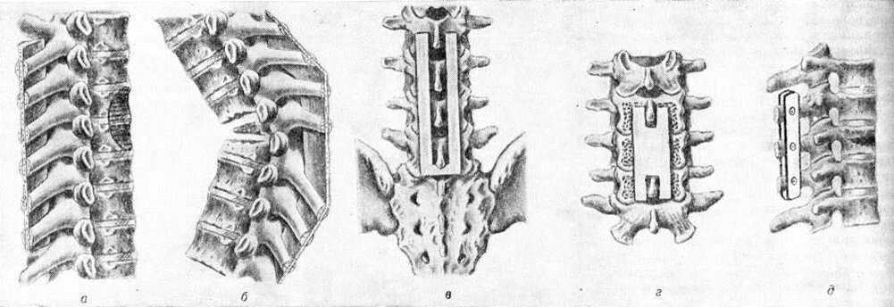 Схематическое изображение различных видов заднего спондилодеза: а — по Олби (линейный костный трансплантат внедрен в расщепленные остистые отростки; пораженные участки тел позвонков заштрихованы); б — по Корневу (в расщепленные остистые отростки внедрен костный трансплантат в виде скобы, форма которой соответствует искривлению позвоночника); в — по Козловскому (костный трансплантат П-образной формы размещен по сторонам от остистых отростков позвонков); грамм — по Босуорту (Н-образный костный трансплантат уложен на губчатое вещество кости, обнаженное в результате резекции остистого отростка позвонка и задних пластинок компактного вещества дуг позвонков); д — фиксация задних отделов позвоночника с помощью металлических пластин и болтов (участок поражения тела позвонка закрашен черным, верхушки остистых отростков фиксированных позвонков резецированы).