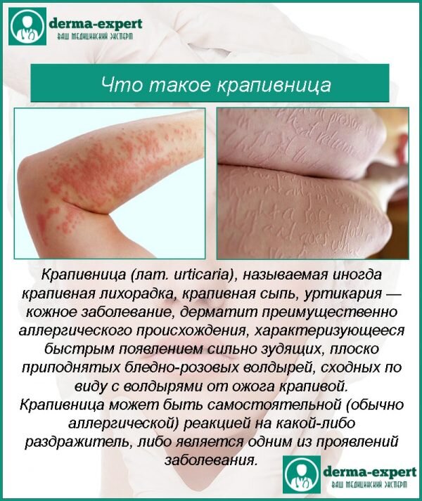Что такое крапивница