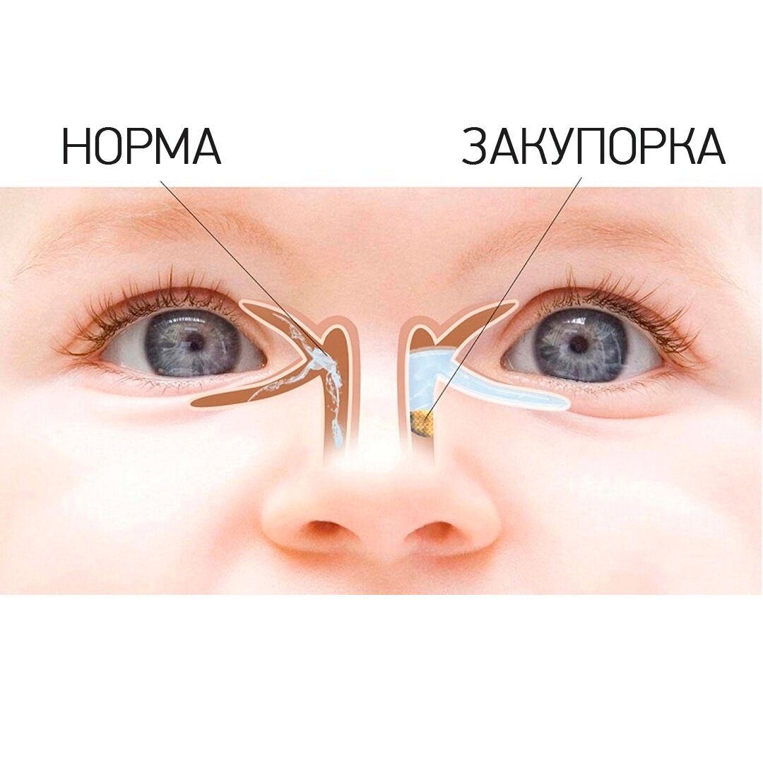 Дакриоцистит новорожденных