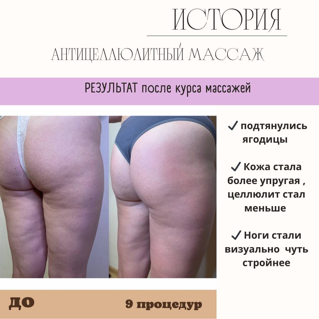 Схема антицеллюлитного массажа руками