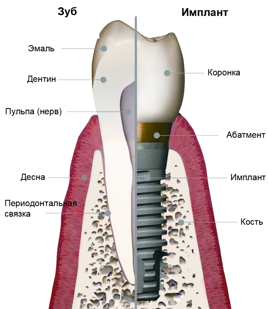 Устройство импланта. Строение дентального импланта. Строение имплантата зуба. Строение зуба с имплантом. Абатмент на зубной имплант.
