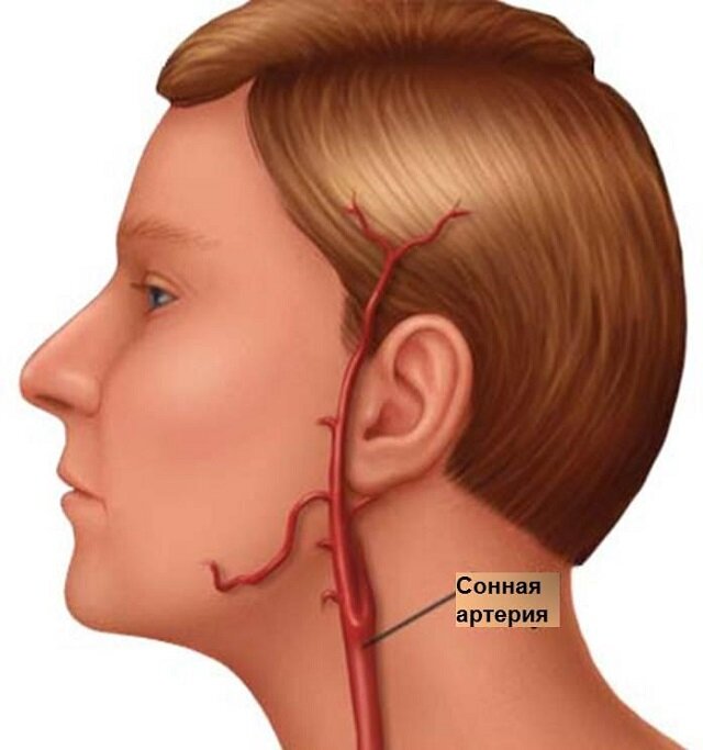 Сонная артерия вырубить человека. Сонная артерия расположение. Атеросклероз сосудов сонных артерий.