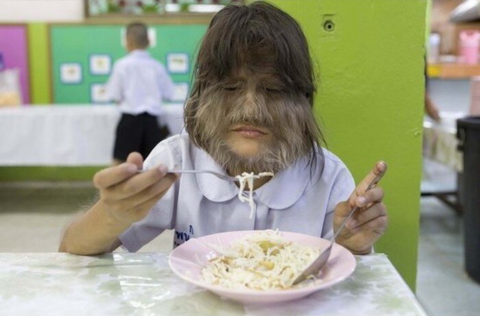 Супатра Сасупфан призналась, что титул "самой волосатой девочки в мире" в Книге рекордов Гиннеса придал ей уверенности, и она занялась танцами, пением и актерским мастерством.