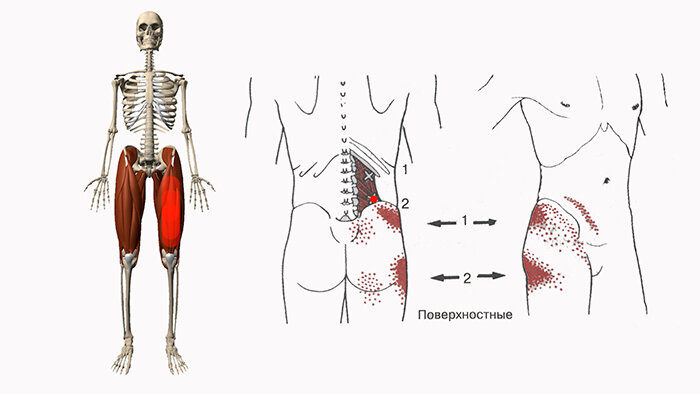 Триггерные точки бедра