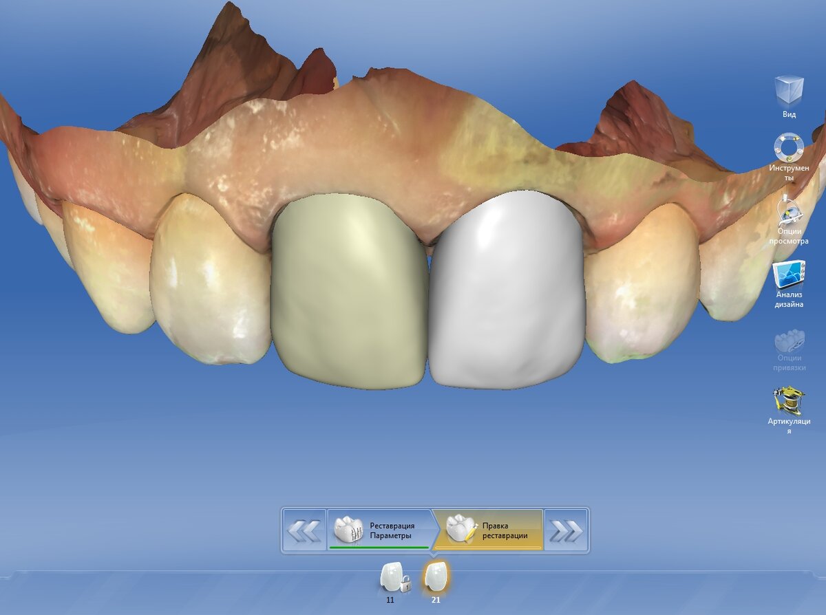 Зубы из цифрового цирка. CAD cam CEREC зубы.