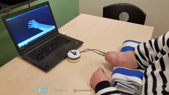 Первому человеку с ампутацией ниже локтя имплантировали костно-нервно-мышечный протез. Доступ к электродам, имплантированным в нервы и мышцы, осуществляется с помощью двух титановых имплантатов, которые служат для скелетного прикрепления и взаимодействия с протезом. Протез является виртуальным в течение периода восстановления после операции, чтобы оценить интерфейс.
Предоставлено: доктор Макс Ортис Каталон