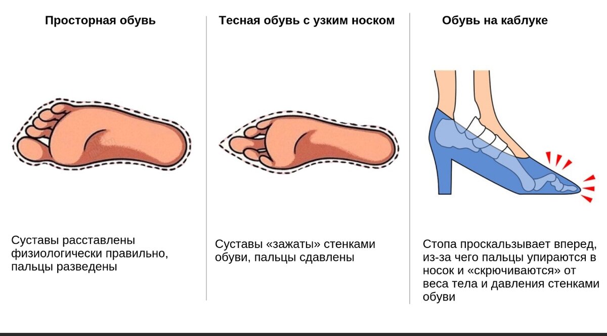 Тесная обувь