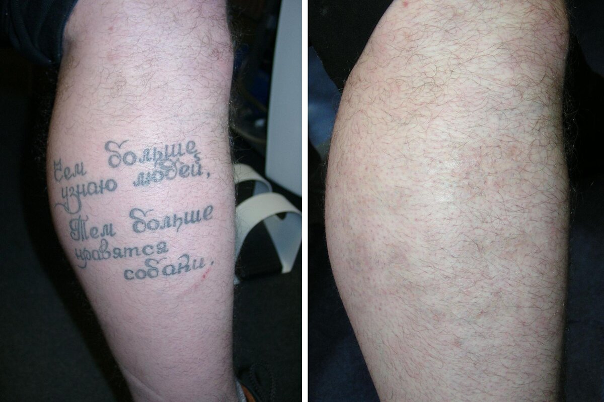 Удаление тату: реально ли избавиться от рисунка полностью | Master Tattoo |  Дзен