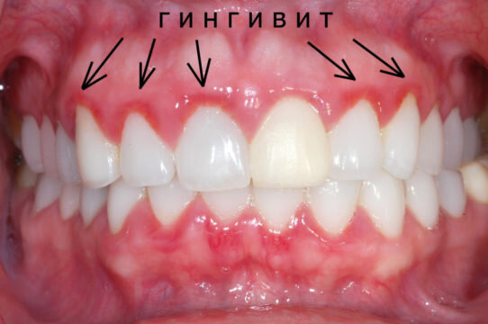 Источник: https://ozubkah.ru