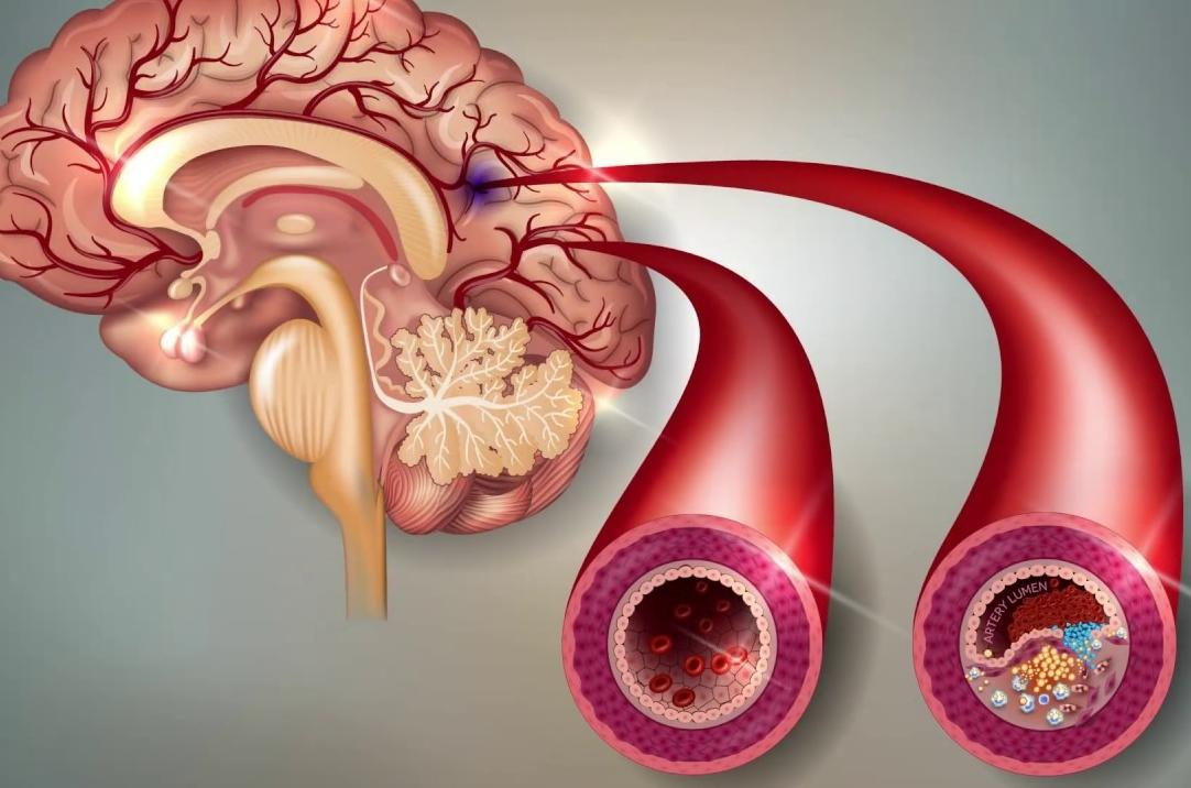 Чистка тромба. Бляшка в сосудахголовного моззга. Атеросклероз сосудов головного мозга. Атеросклероз артерий головного мозга.