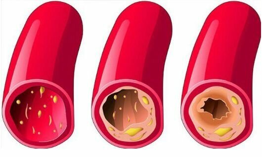 1 из 3É assim que os vasos ficam sujos, de forma gradual. Se nunca limpou os seus vasos sanguíneos e tem mais de 40 anos, eles contêm muitas impurezas. Isto pode afetar a sua saúde ou talvez este processo já tenha iniciado.