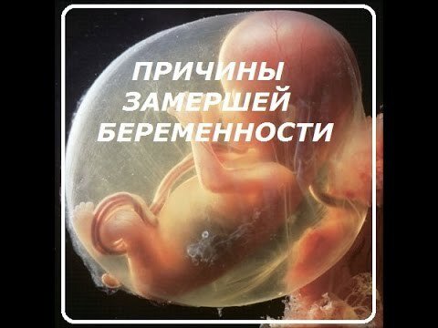 Причины замершей беременности 