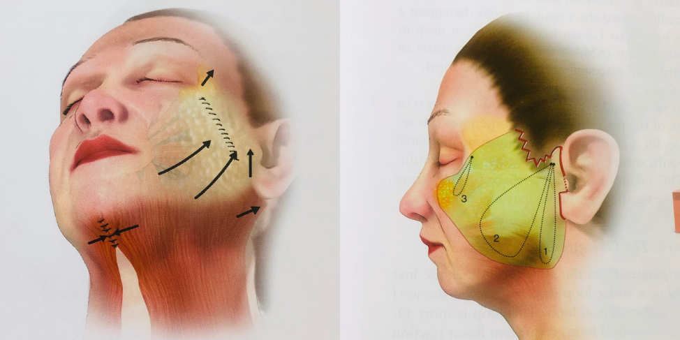 Зона операции. Косметические разрезы на лице. Смас лифтинг схема операции. Разрезы при смас лифтинге.