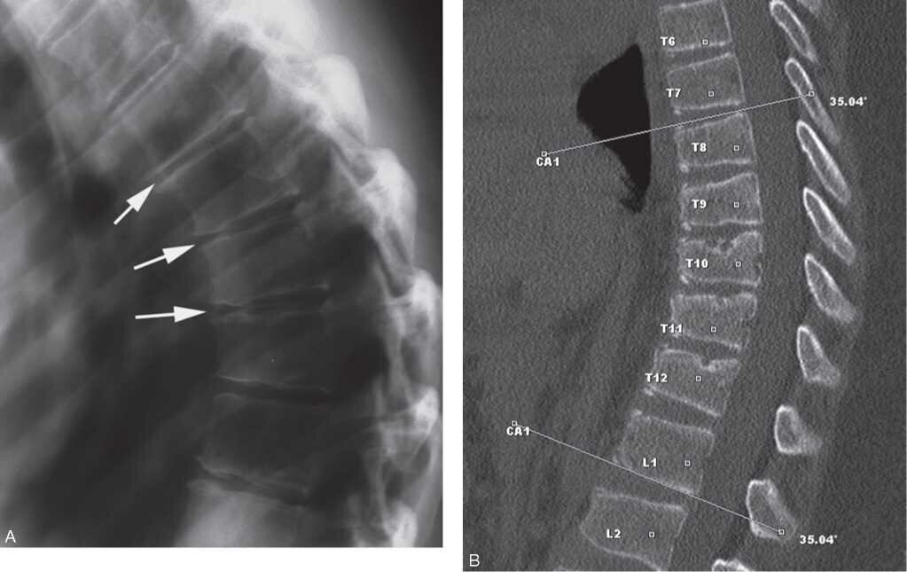 болезнь Шеермана-Мау