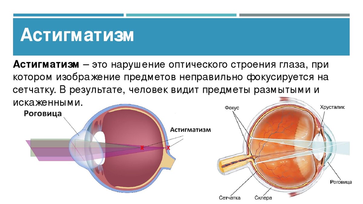 Нарушение зрения таблица астигматизм. Строение астигматического глаза. Глаз при астигматизме схема. Строение глаза астигматизм. Сложный гиперметропический астигматизм глаз