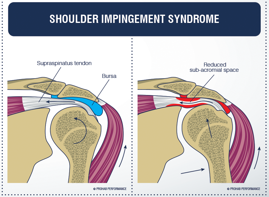 Импиджмент сустава. Импинджмент синдром плечевого сустава. Субакромиальный импинджмент-синдром плечевого сустава. Мышцы ротаторной манжеты плечевого сустава. Импинджмент синдром вращательной манжеты плечевого сустава.