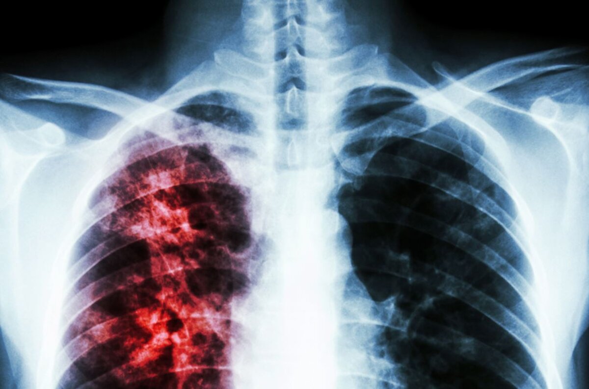 В 2021 году Россия достигла исторического минимума по смертности от туберкулеза.