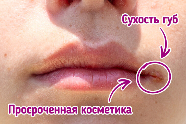 О чем говорят трещинки в уголках губ, и как от них избавиться