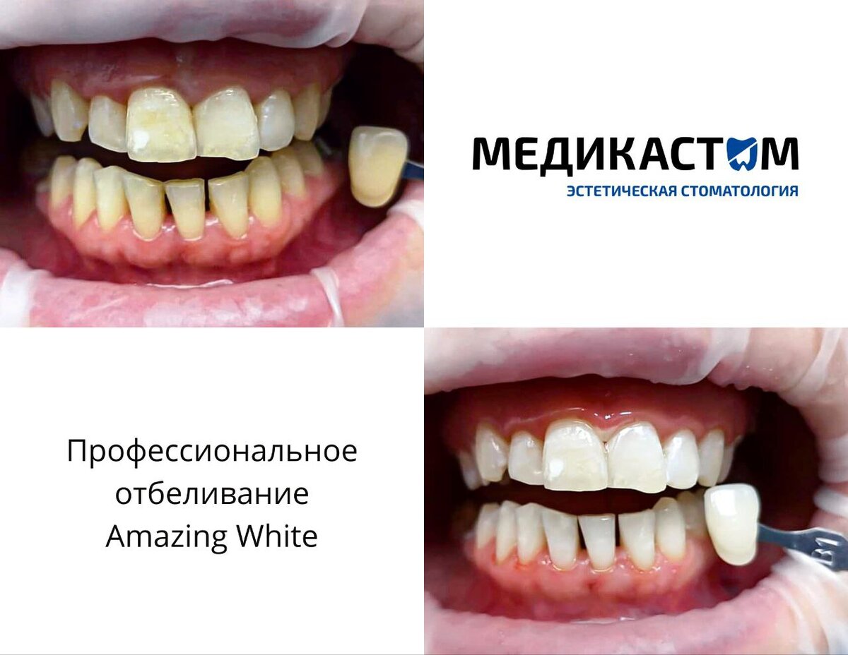 Наши опытные врачи способны быстро отбелить эмаль с применением современных высококачественных препаратов и установок.