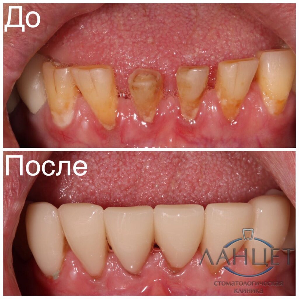 Восстановление 33 32 31 41 42 43 зубов винирами CAD/CAM I-MAX при патологической стираемости зубов.
Врач Ланцет Д.Г.