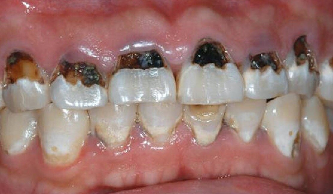 Наглядный пример, что может быть, если пить Колу вместо воды на протяжении нескольких лет