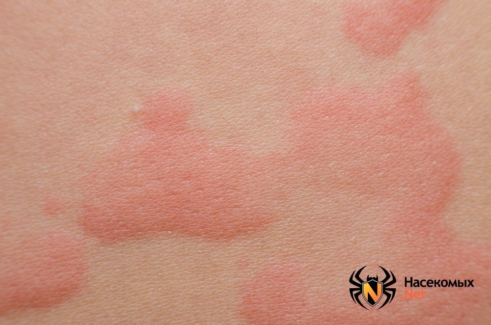 Укусы комара